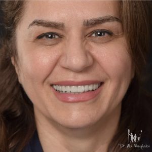 ونیر کامپوزیت دندان اصفهان