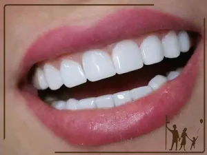 لمینت دندان