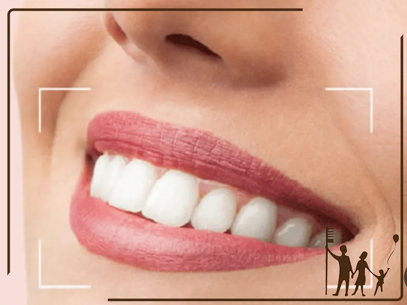 محدودیت‌های طراحی لبخند