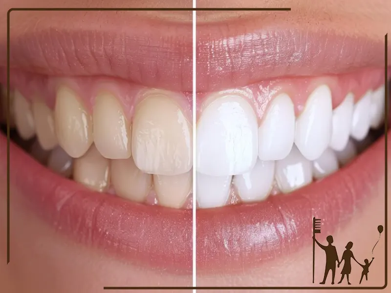 نکاتی که قبل از بلیچینگ باید بدانید