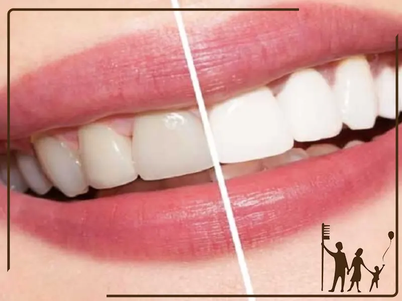 تفاوت بلیچینگ با لمینت و کامپوزیت