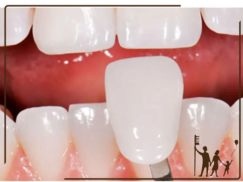 آیا دندان‌های لمینت شده جرم می‌گیرند؟