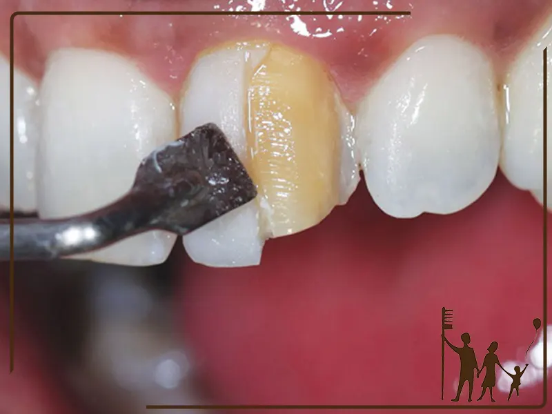 بررسی ماندگاری کامپوزیت دندان با تکنولوژی میکروسکوپی