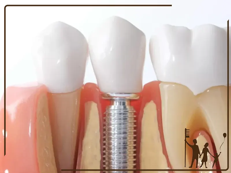 مراقبت‌های بعد از کاشت ایمپلنت دندان