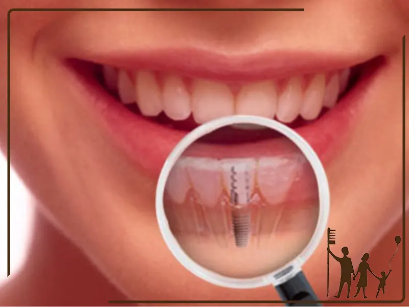 بهترین سن برای کاشت ایمپلنت دندان