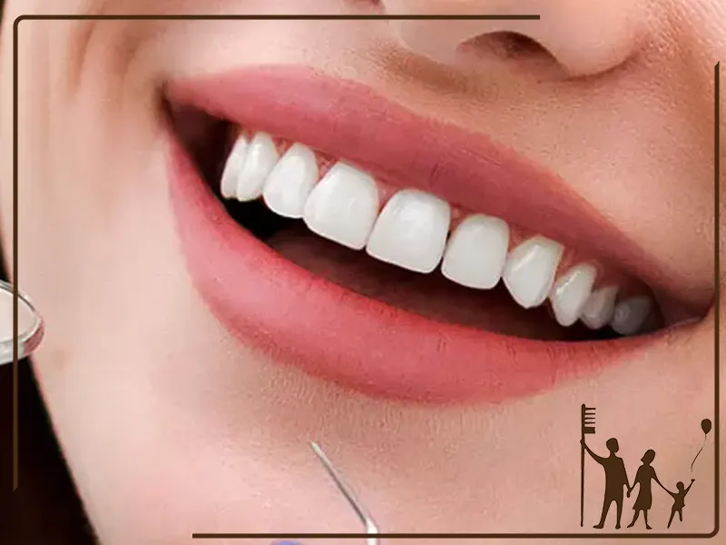 مراقبت‌های لازم بعد از لمینت دندان