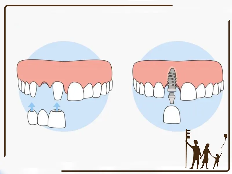 تفاوت ایمپلنت تک دندان با چند دندان
