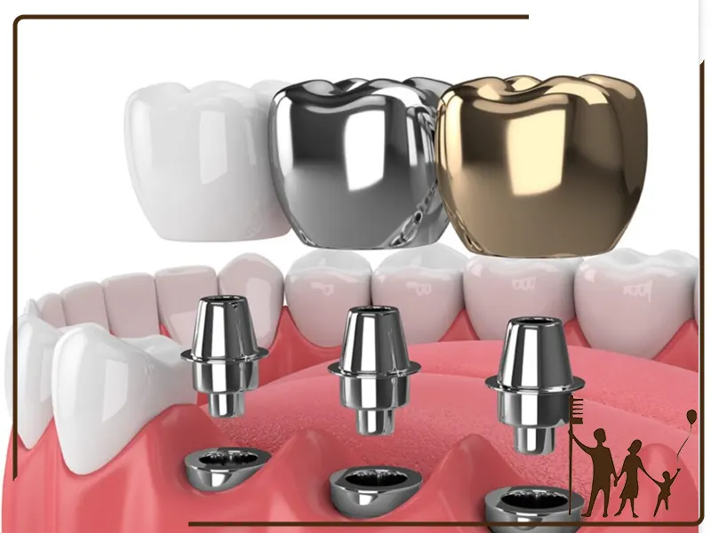 بهترین برندهای ایمپلنت دندانی در ایران