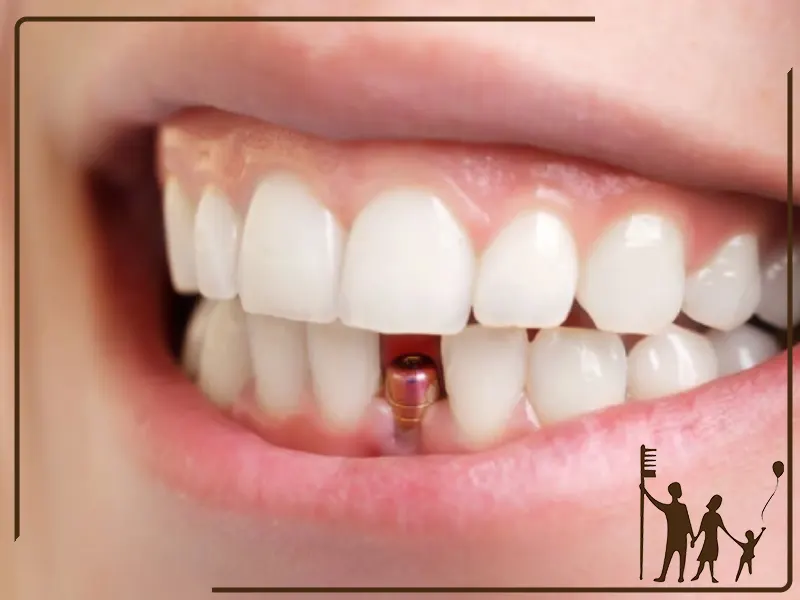 آیا ایمپلنت دندان درد دارد؟