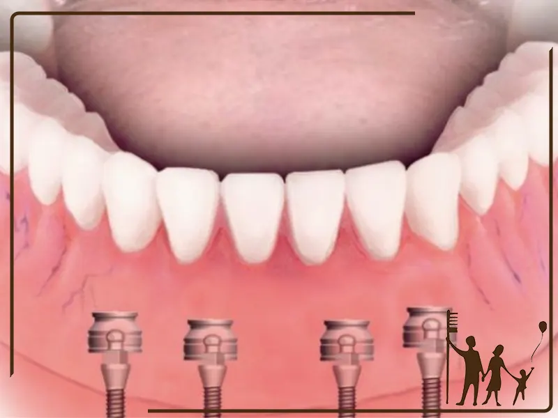 مراحل کاشت ایمپلنت دندان با دقت میکروسکوپی