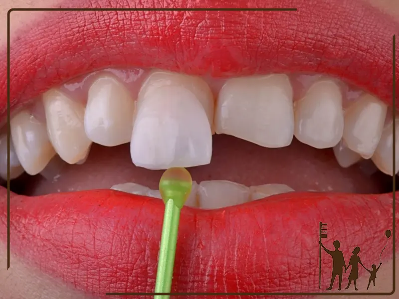 مزایا و معایب لمینت دندان