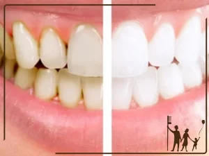 بلیچینگ یا جرمگیری؟ کدام بهتر است؟