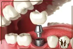راهنمای جامع ایمپلنت دندان