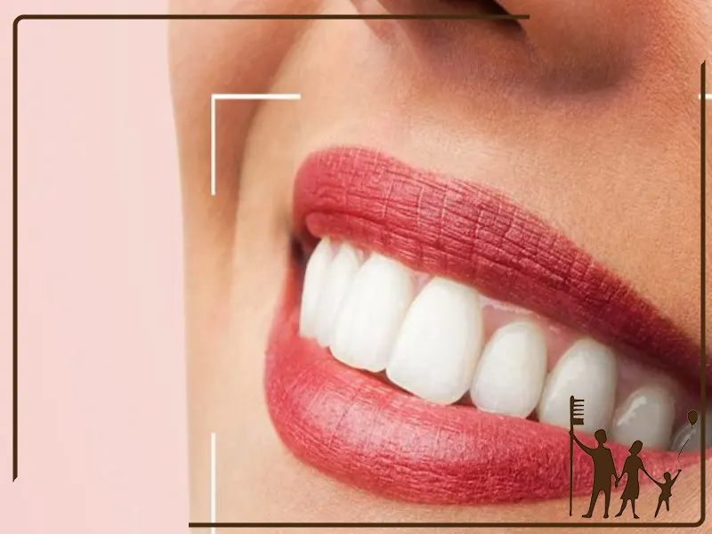 بلیچینگ دندان روی لمینت