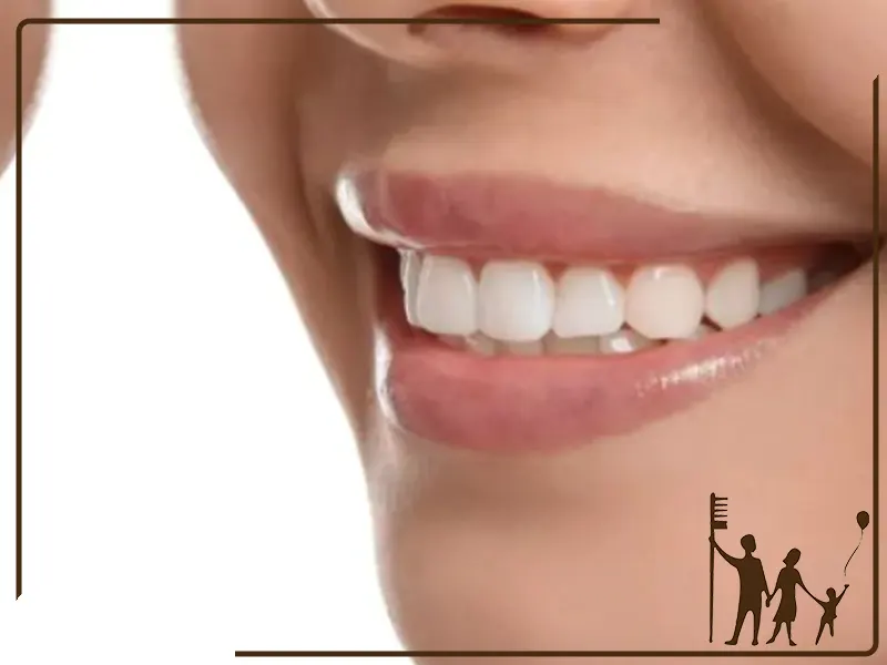 بهترین برند لمینت سرامیکی دندان در ایران